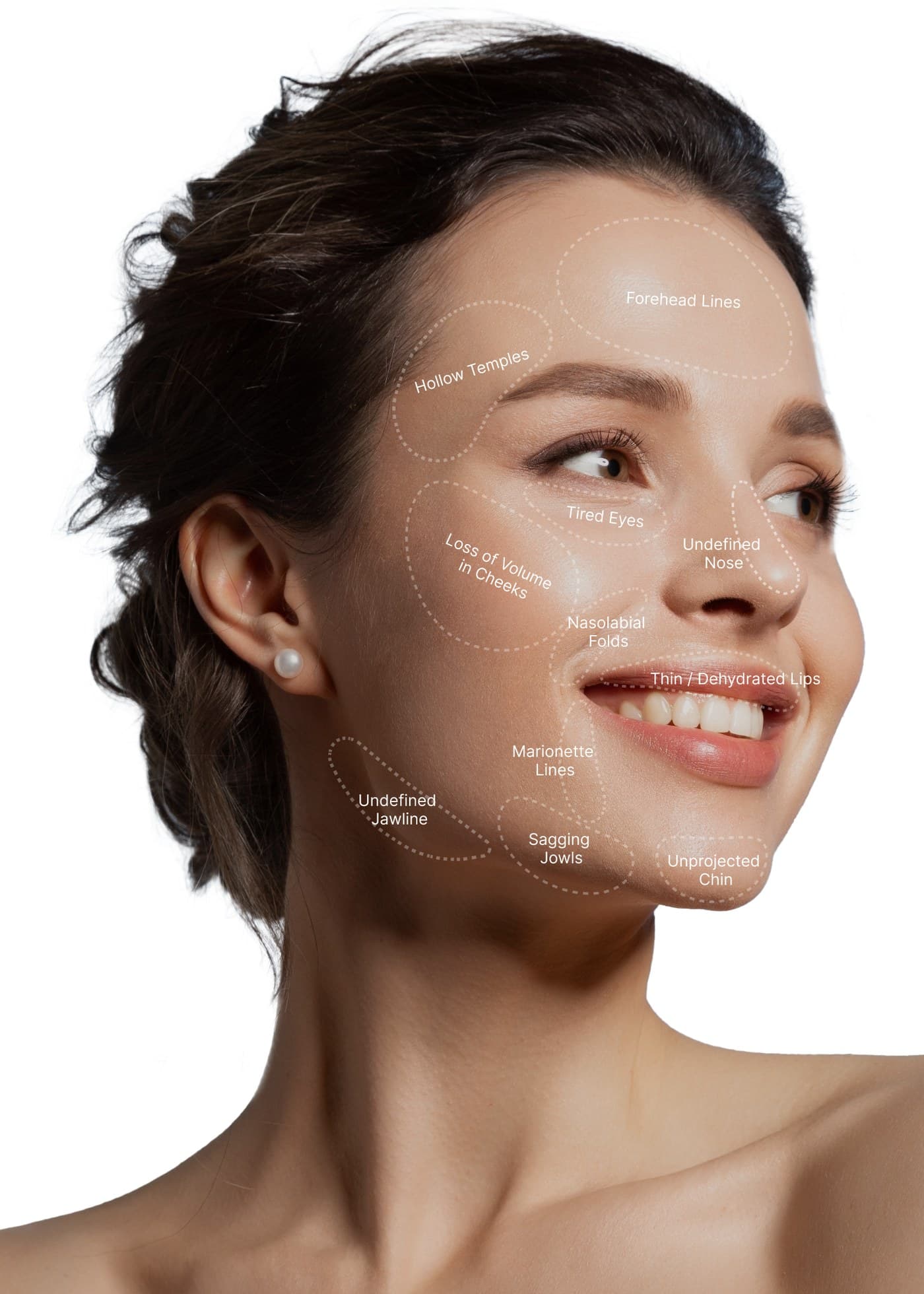 Diagram of facial areas treated with dermal filler, including temples, cheeks, nasolabial folds, lips, jawline and chin